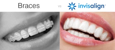 Before-and-after-Invisalign-1